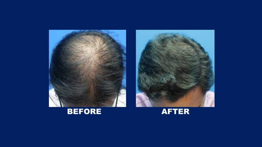 FUE Male Hair Transplant Centre Malaysia