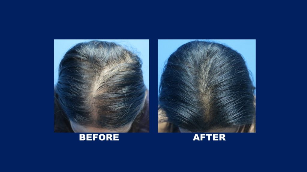 FUE Female Hair Transplant Before And After Results Done By Hair Transplant Centre Malaysia