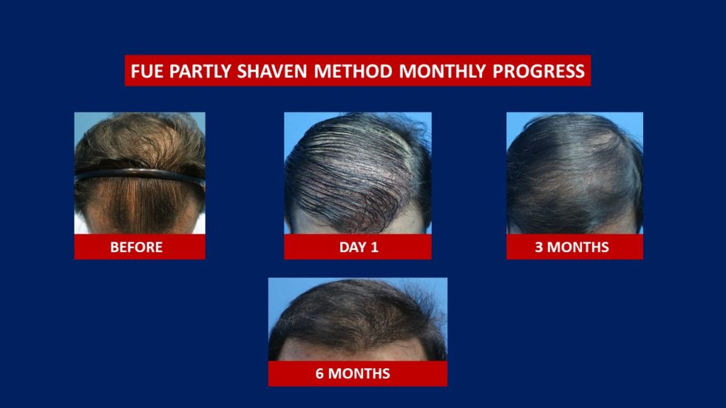 FUE Male Hair Transplant Partly Shaven Method Before And After