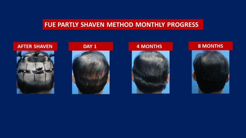 FUE Male Hair Transplant Partly Shaven Method Donor Area Before And After
