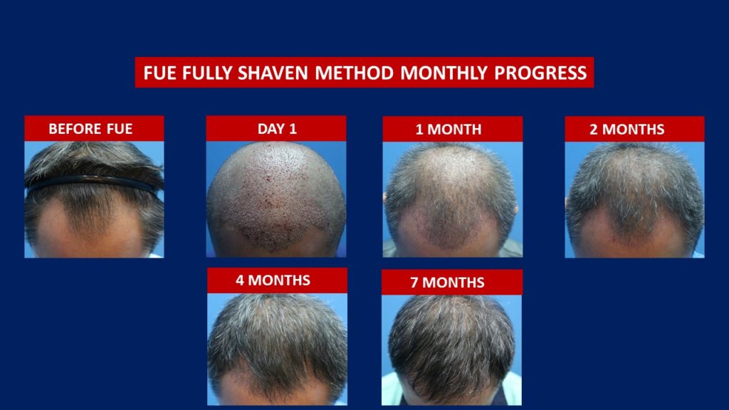 FUE Male Hair Transplant Fully Shaven Method Before And After
