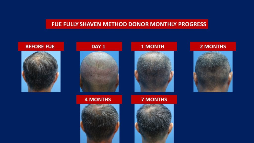 FUE Male Hair Transplant Fully Shaven Method Donor Area Before And After