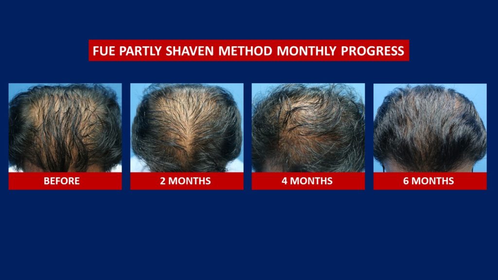 FUE Male Hair Transplant Partly Shaven Method Before And After 6 Months Results