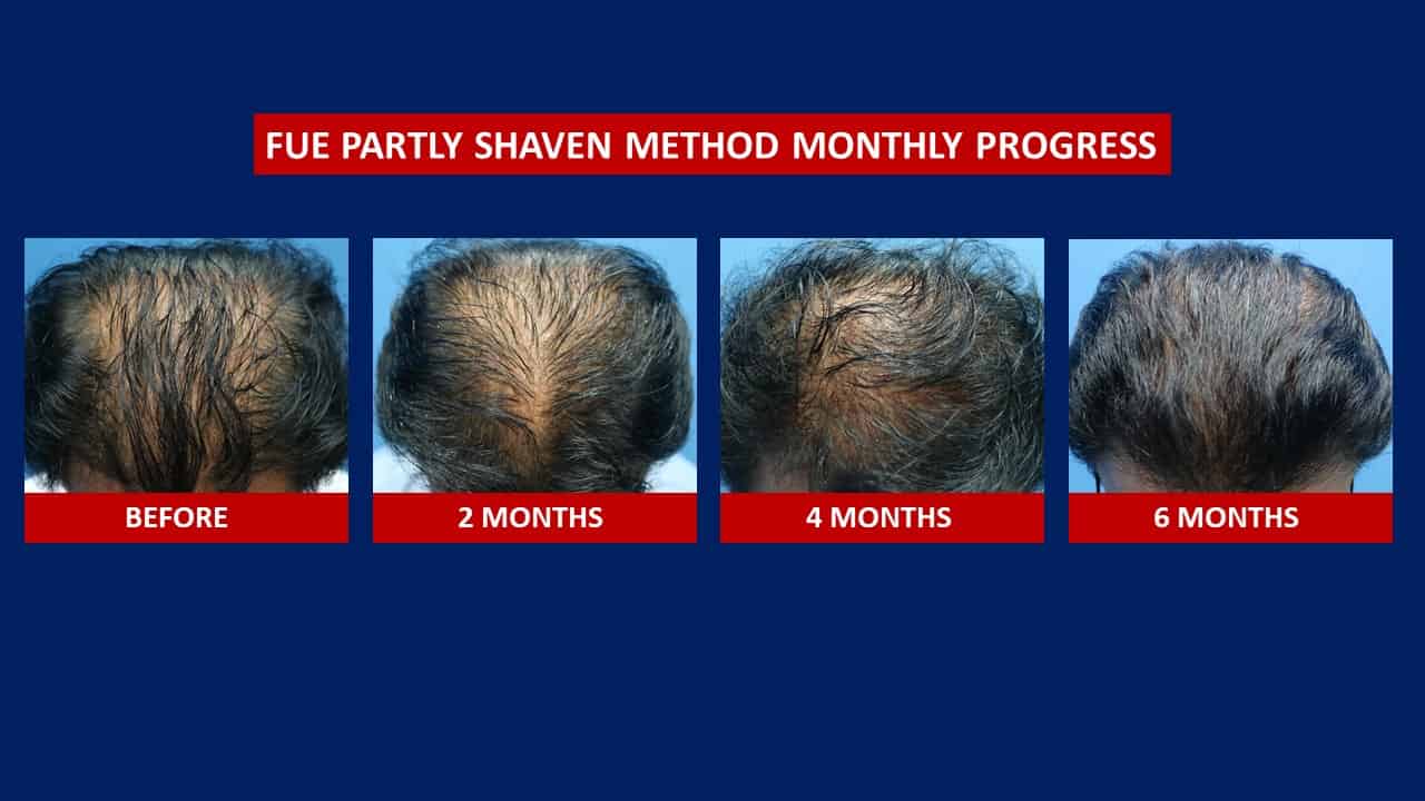 Hair Transplant Journey Hair Transplant After 3 Months  Trichohom Results