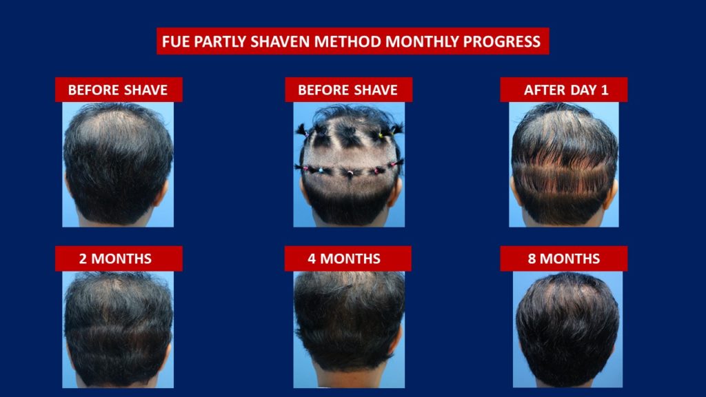 FUE Male Hair Transplant Partly Shaven Method Donor Area Before And After 8 Months Progress