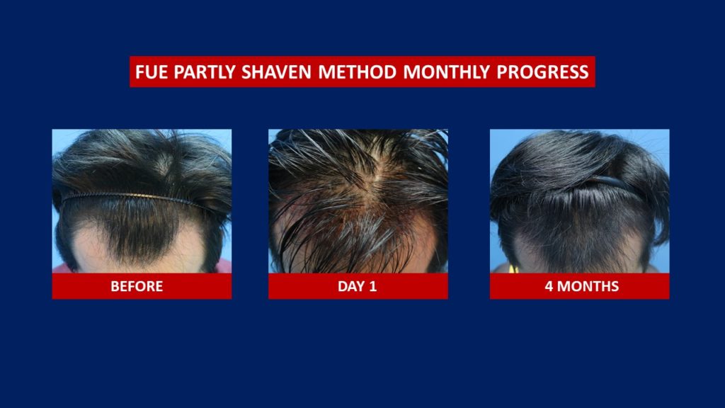 FUE Male Hair Transplant Partly Shaven Method Before And After 4 Months Results