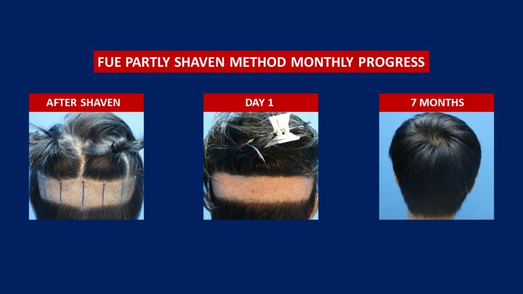 FUE Male Hair Transplant Partly Shaven Method Donor Area Before And After 7 Months Progress