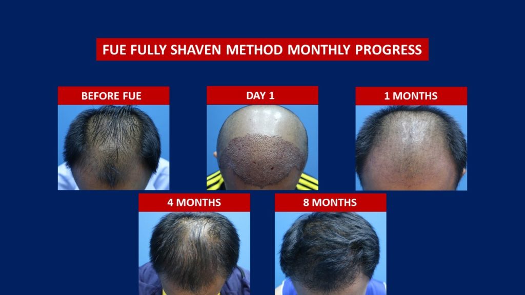 FUE Male Hair Transplant Fully Shaven Method Before And After 8 Months Results