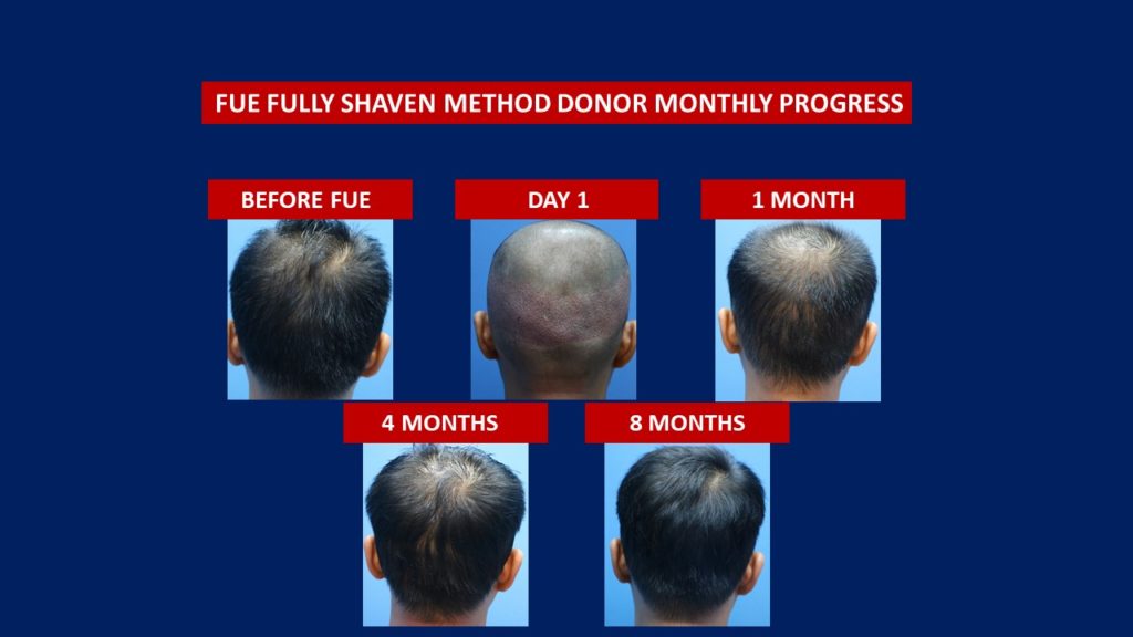 FUE Male Hair Transplant Fully Shaven Method Donor Area Before And After 8 Months Results