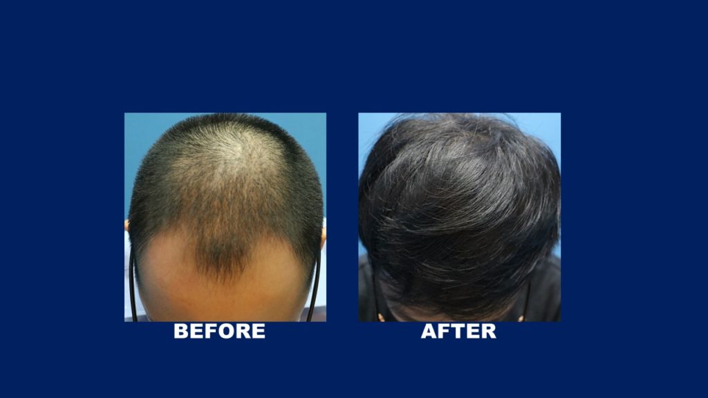 FUE Male Hair Transplant Results