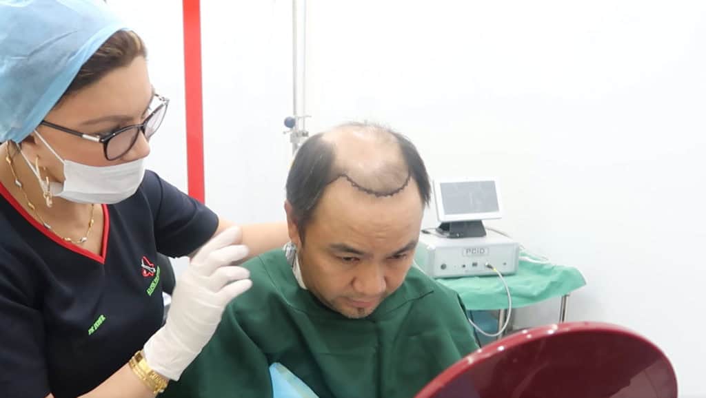 Hair Transplant Procedure