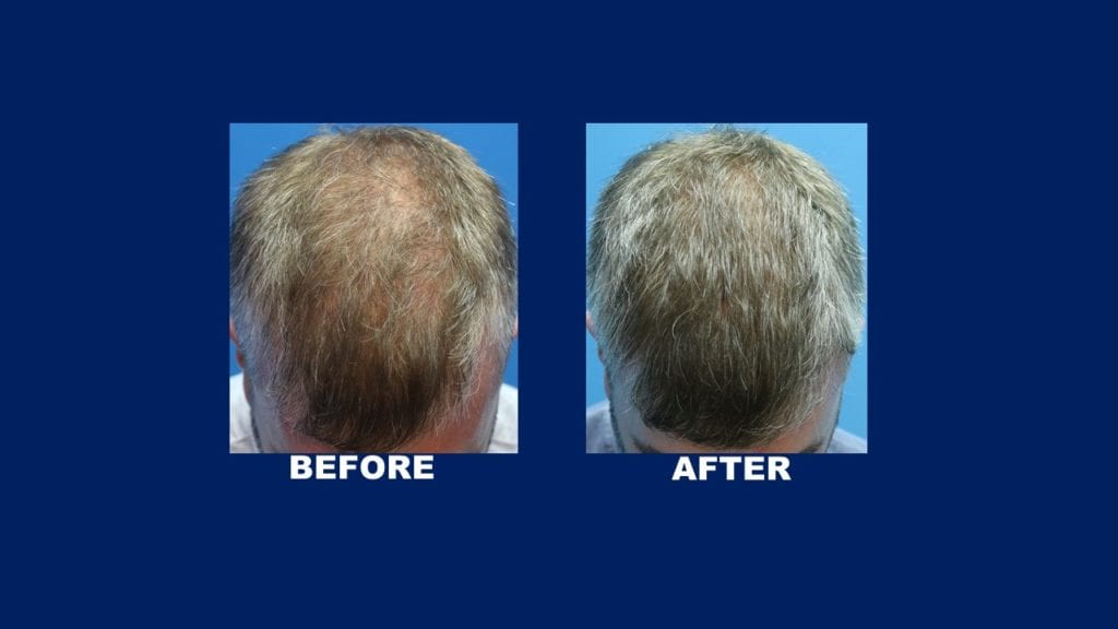 FUE Male Hair Transplant Results At Malaysia