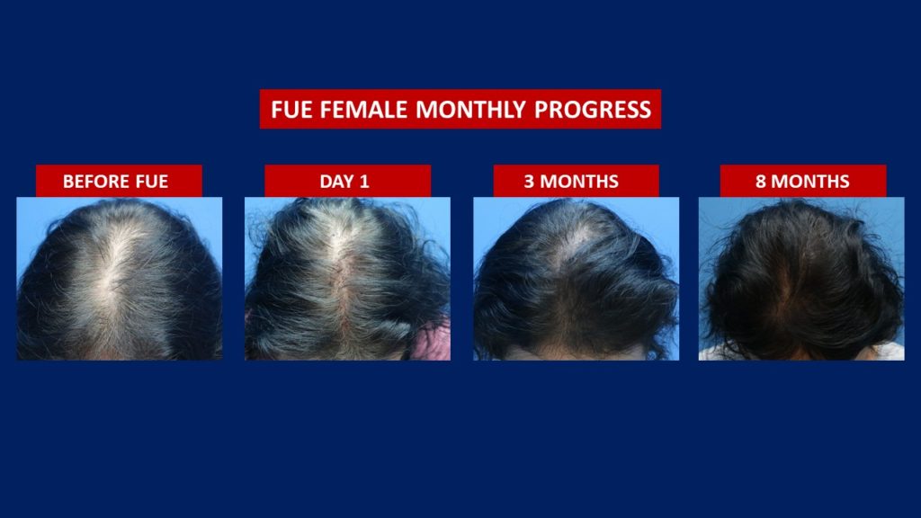 FUE Female Hair Transplant Before And After 8 Months Results Done At Hair Transplant Centre Malaysia