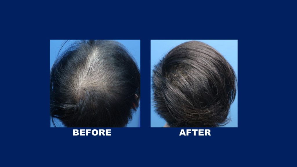 FUE Male Hair Transplant At Crown Area Before And After Results