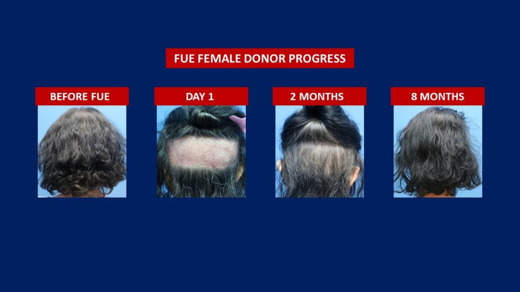 FUE Female Hair Transplant Donor Area Before And After 8 Months Results Progress At Hair Transplant Centre Malaysia