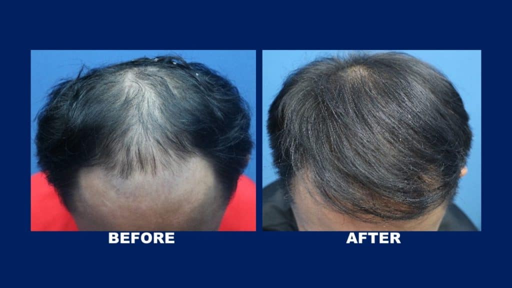 Hair Transplant For Male Pattern Baldness At Hair Transplant Centre Malaysia