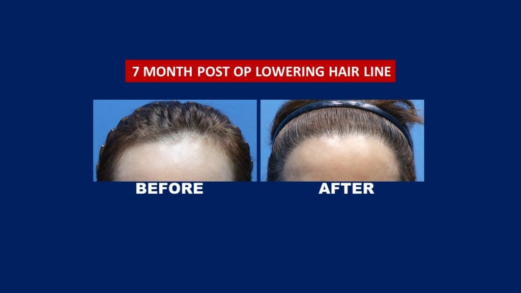 Fue Female hair Transplant