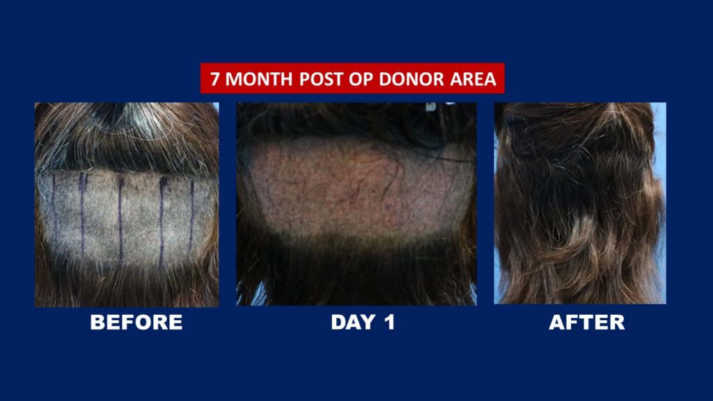 7 Month Post of Donor Area