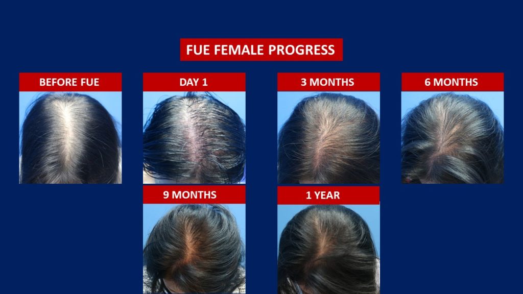FUE Female Hair Transplant Before And After 1 year Results Done At Hair Transplant Centre Malaysia
