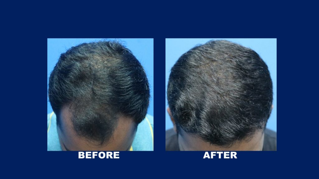 FUE Male Hair Transplant Results At Malaysia