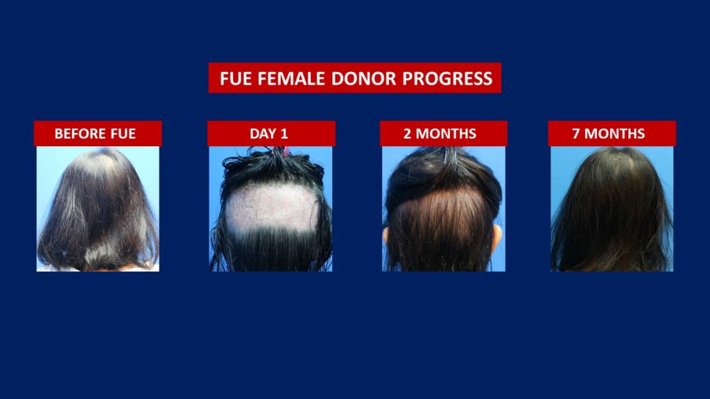 FUE Female Hair Transplant Donor Area Before And After 7 Months Progress Done At Hair Transplant Centre Malaysia