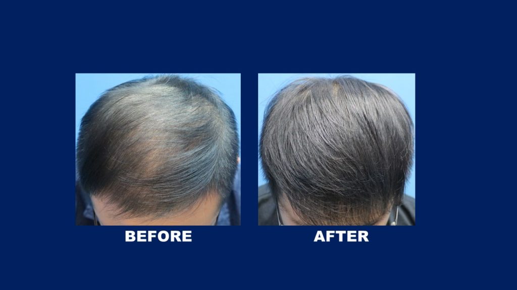 FUE Male Hair Transplant At Malaysia