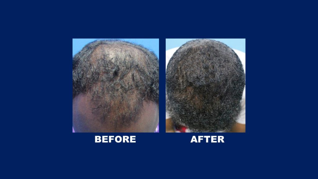 FUE Male Hair Transplant For Afican Hair Before and After Results