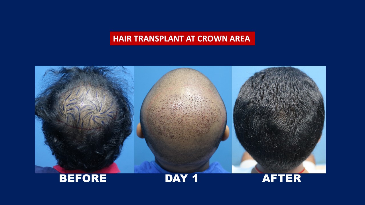 Crown Hair Transplant Before After - Hair Transplant Centre Malaysia