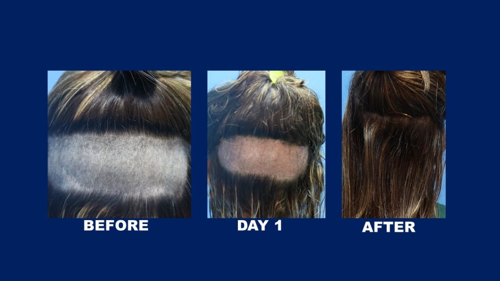 FUE Female Hair Transplant Lowering Hairline Donor Area After 1 year Done At Hair Transplant Centre Malaysia
