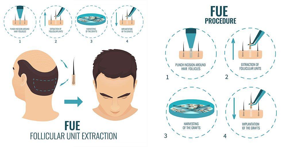 FUE Procedure Info