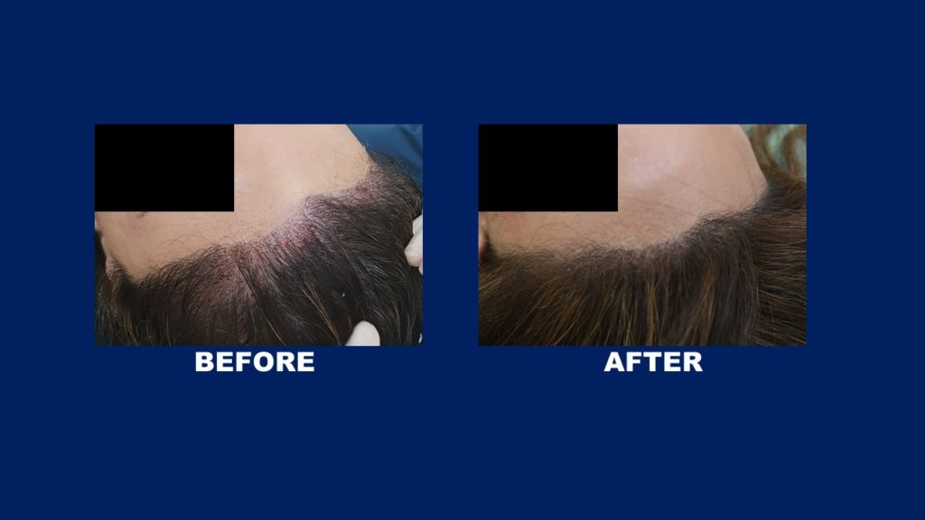 FUE Female Hair Transplant Results At Hair Transplant Centre Malaysia