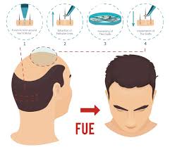 FUE Procedure Info, Hair Transplant Centre Malaysia