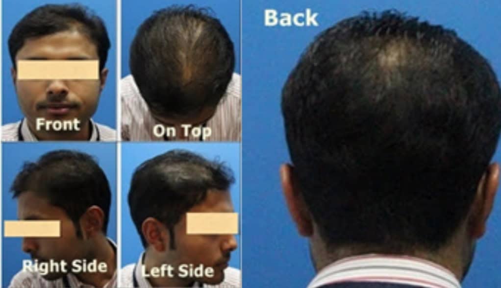 Result for Hair Transplant