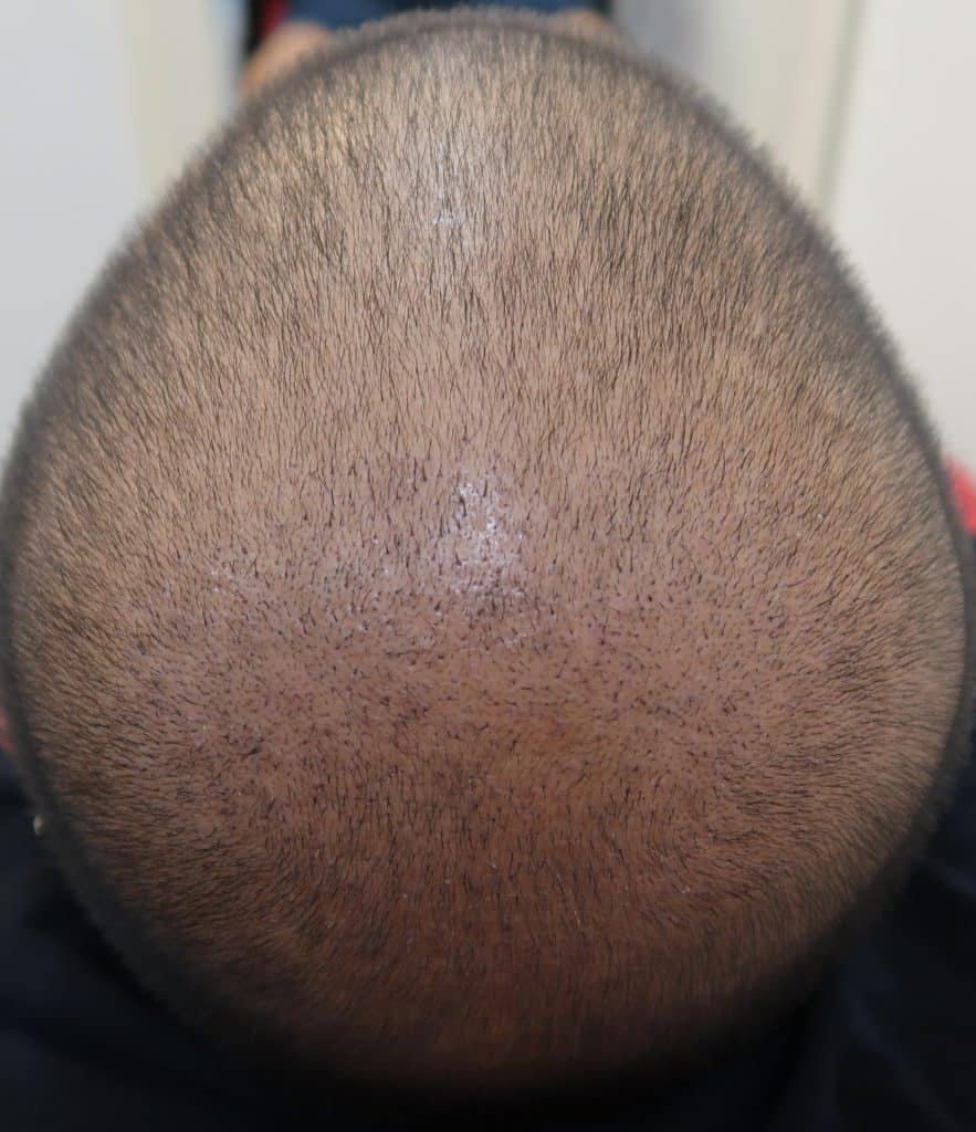 2 Week Result for Fue Hair Transplant
