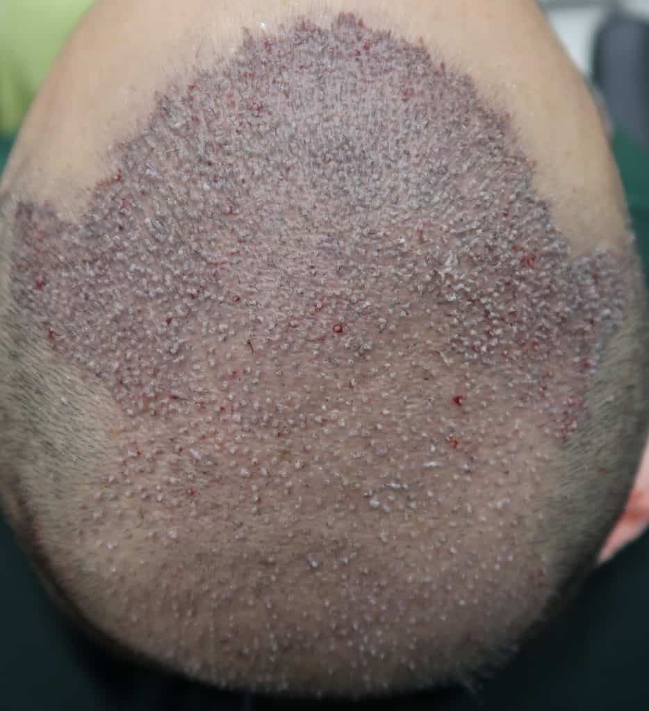 Fue Hair Transplant Timeline for Male