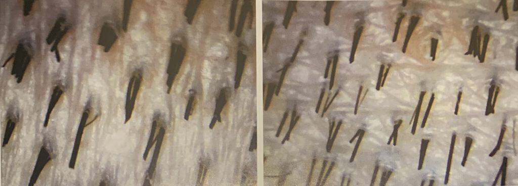 Scalp Analysis Diagram - Hair Transplant Centre Malaysia