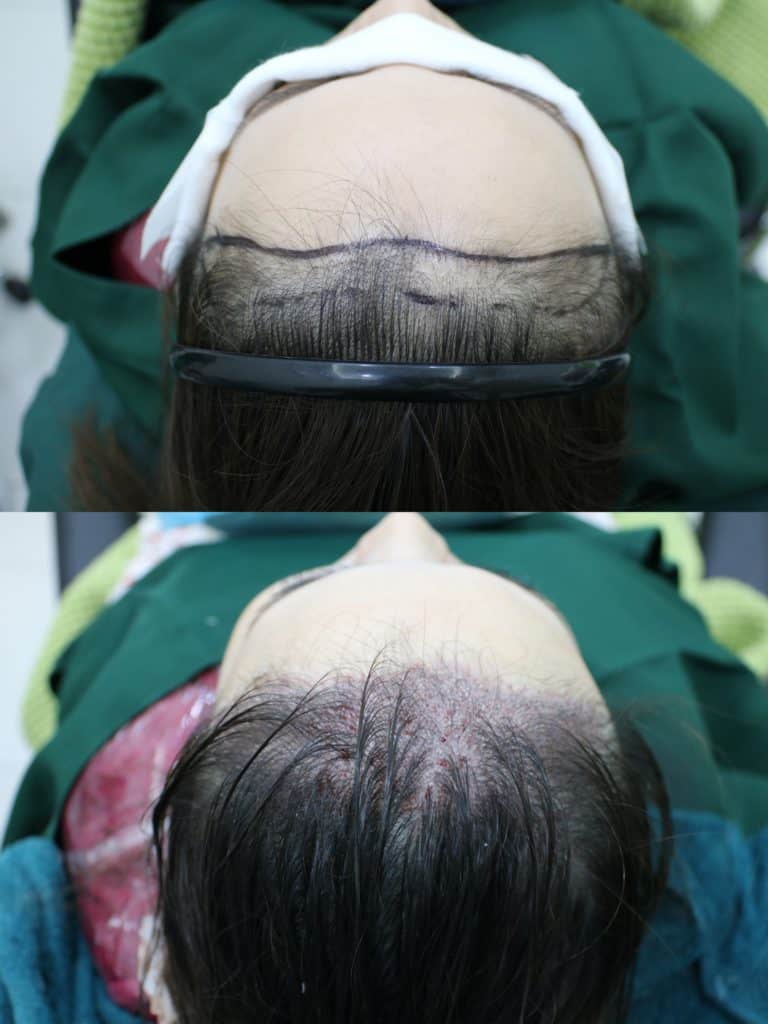 Hair Transplant Centre Malaysia Lowering Female Hair line