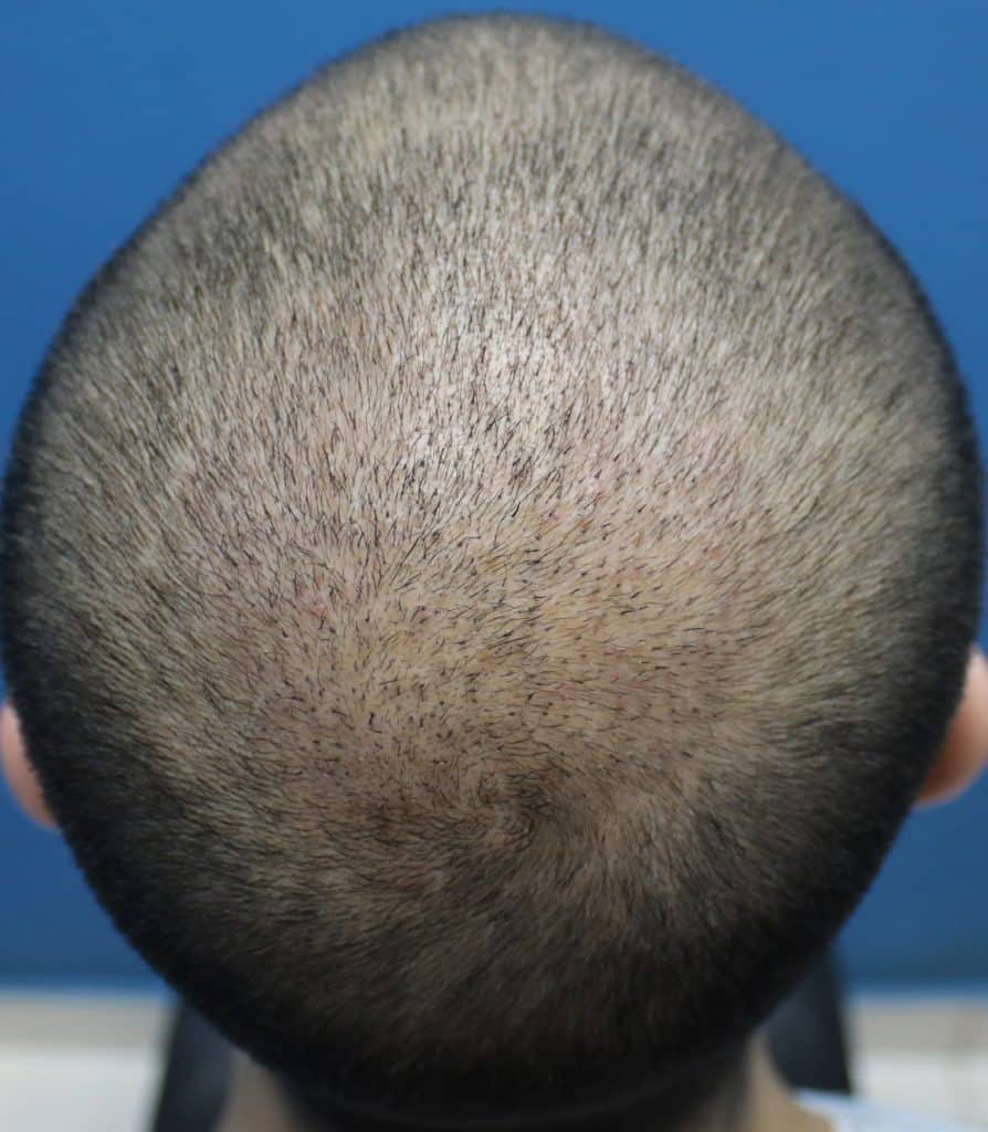 Fue Hair Transplant on 1 Week