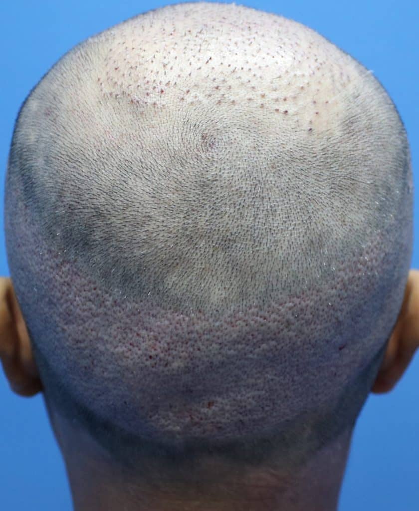 Fue Male Donor on Day 1