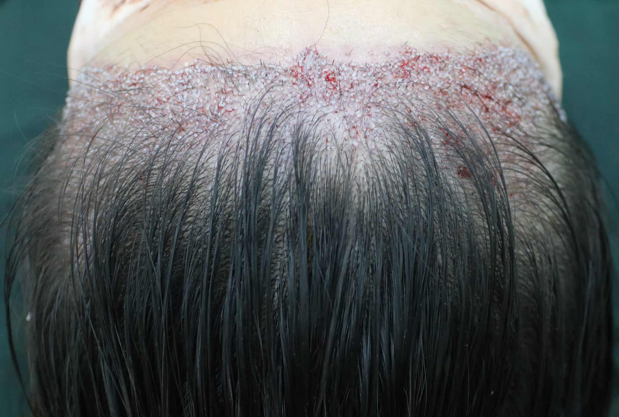 Female Fue Hair Transplant Timeline