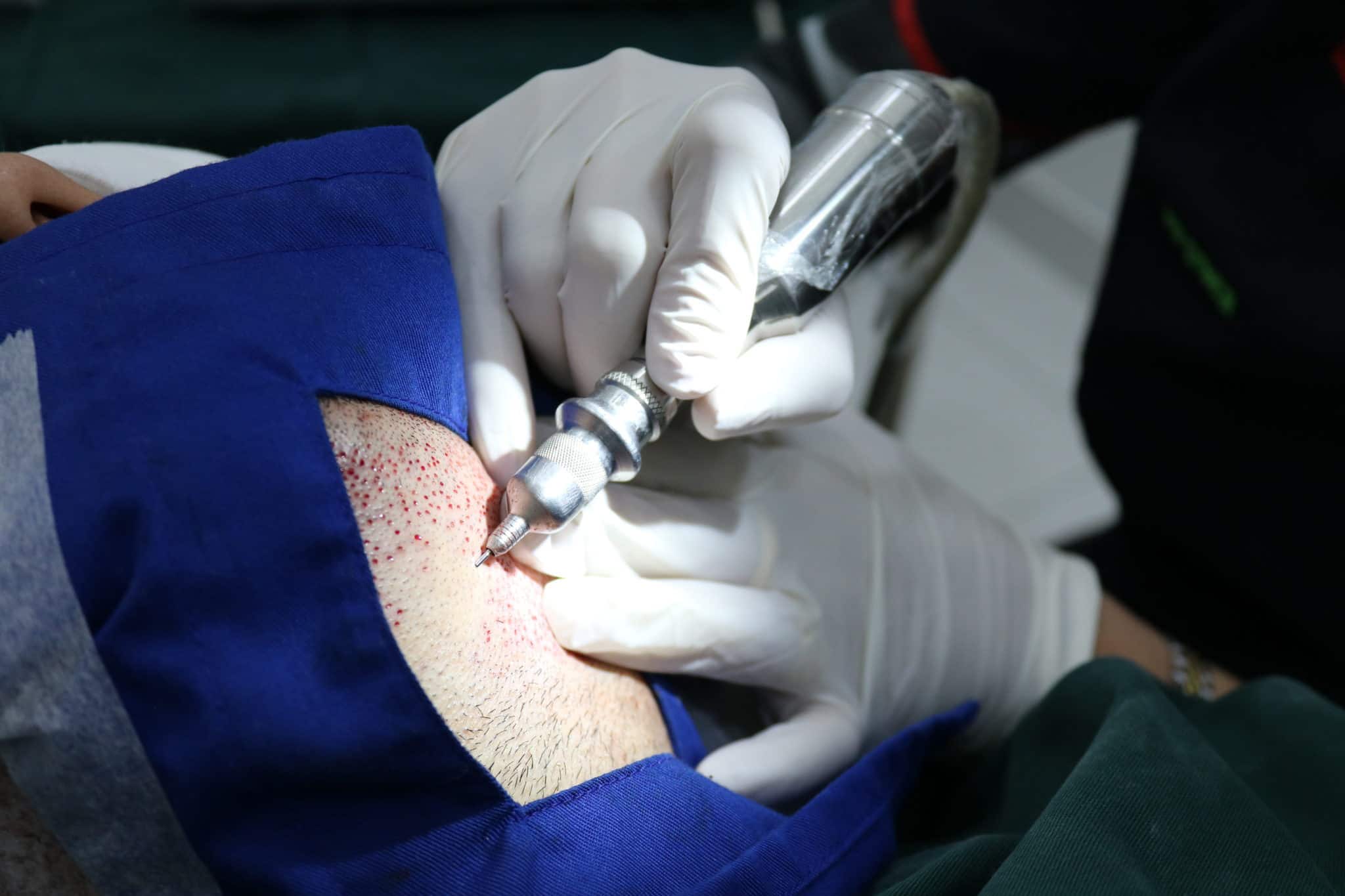 Hair Transplant Centre Malaysia, Dr Inder Harvesting Beard Using PCID By Cole Instruments