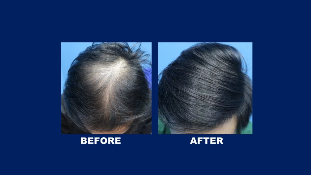 FUE Male Hair Transplant Before And After