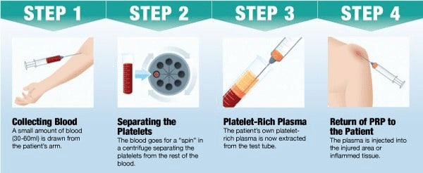 PRP Hair Regrowth Treatment At Hair Transplant Centre Malaysia