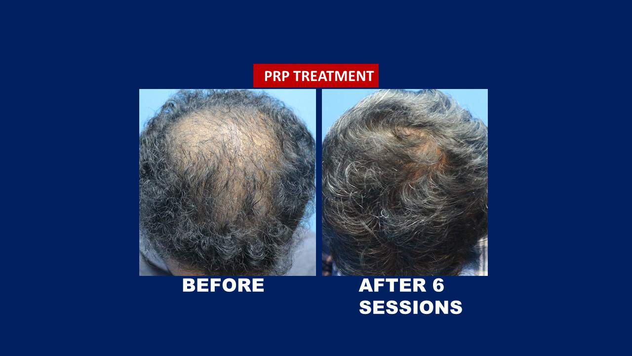 Hair Transplant Centre Malaysia. Before and after 6 session of prp