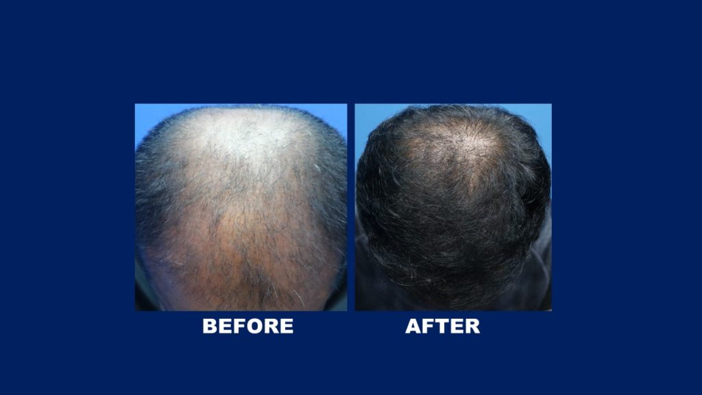 FUE Male Hair Transplant Before and After Results