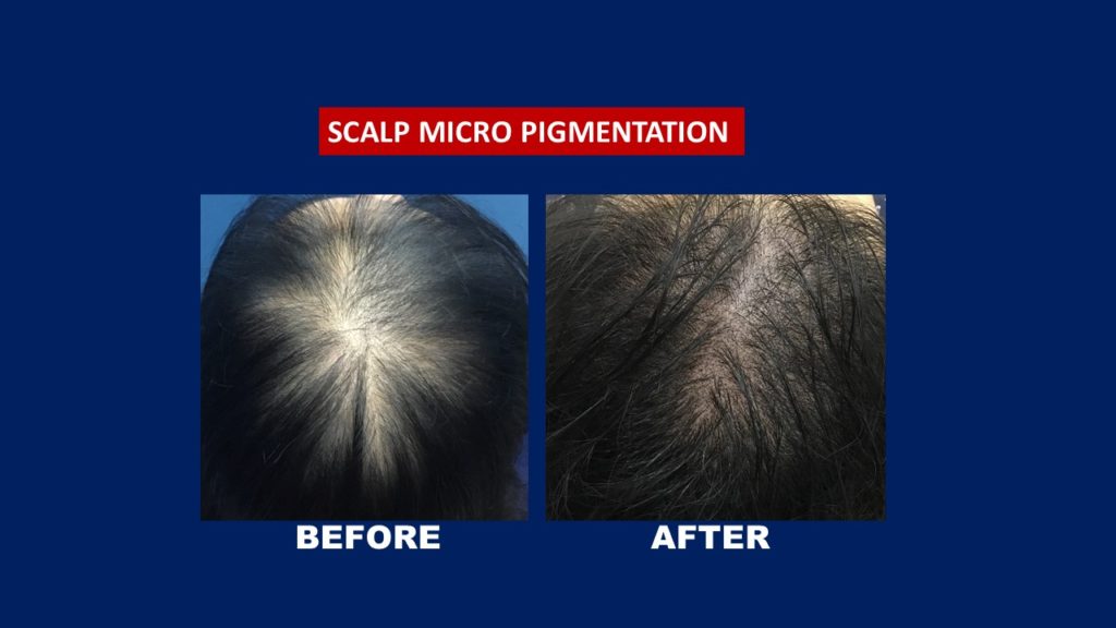 Hair transplant Centre Malaysia. before and after 1 session Scalp Micro Pigmentation
