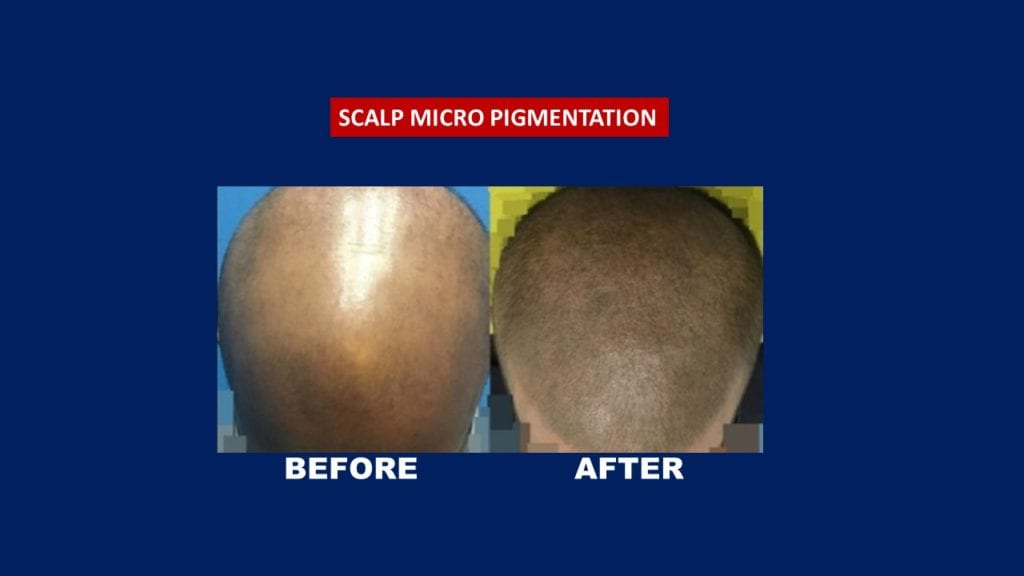 Hair transplant Centre Malaysia. before and after male 2 session Scalp Micro Pigmentation