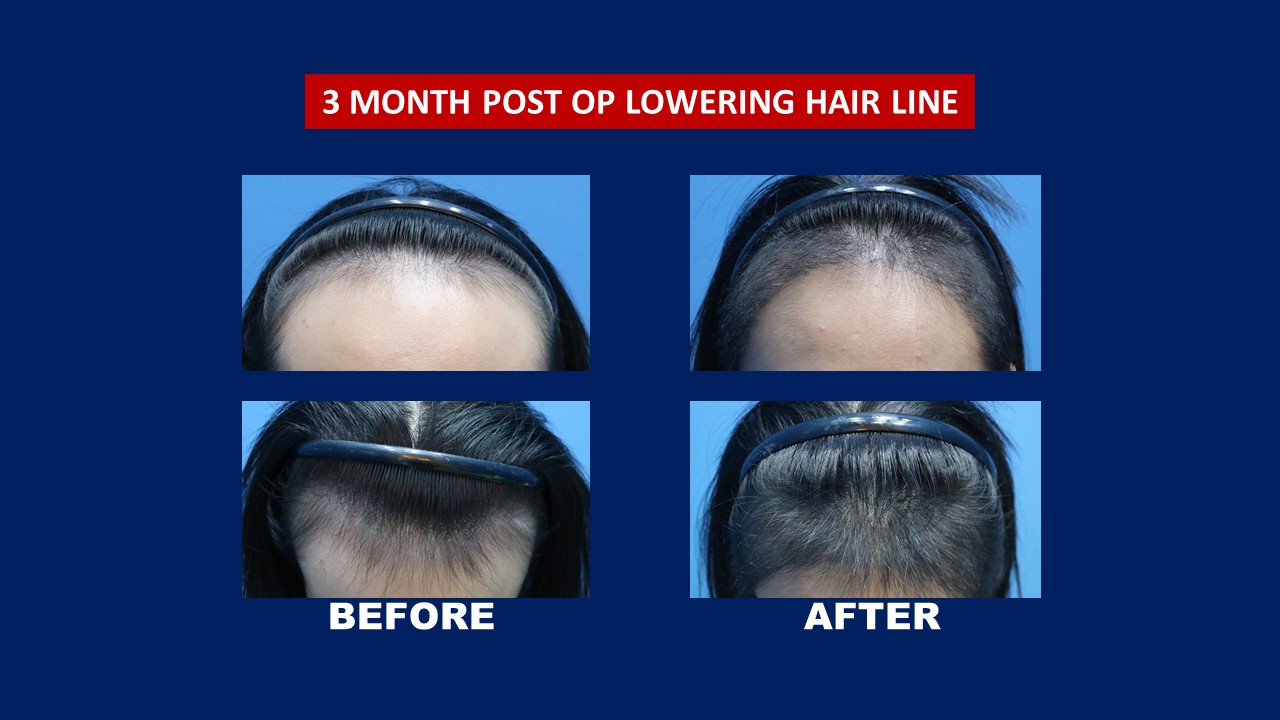 Hair Transplant Centre Malaysia FUE Lowering Female Hair Line 3 Months Results