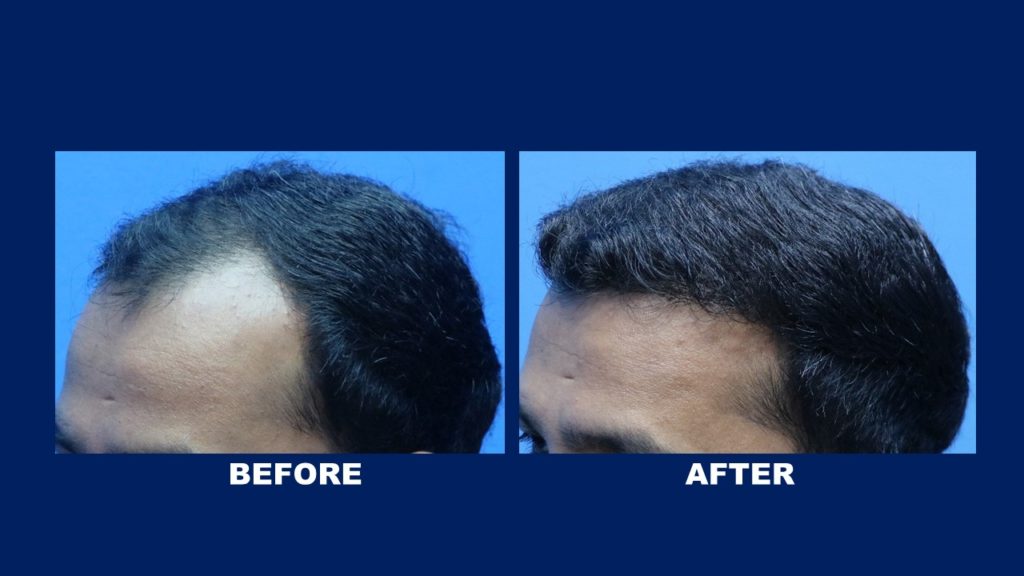 FUE Male Hair Transplant Centre Malaysia Before And After