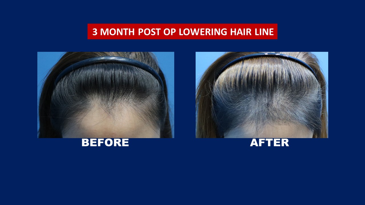 Female Hair Transplant- See Before after Results - Proven